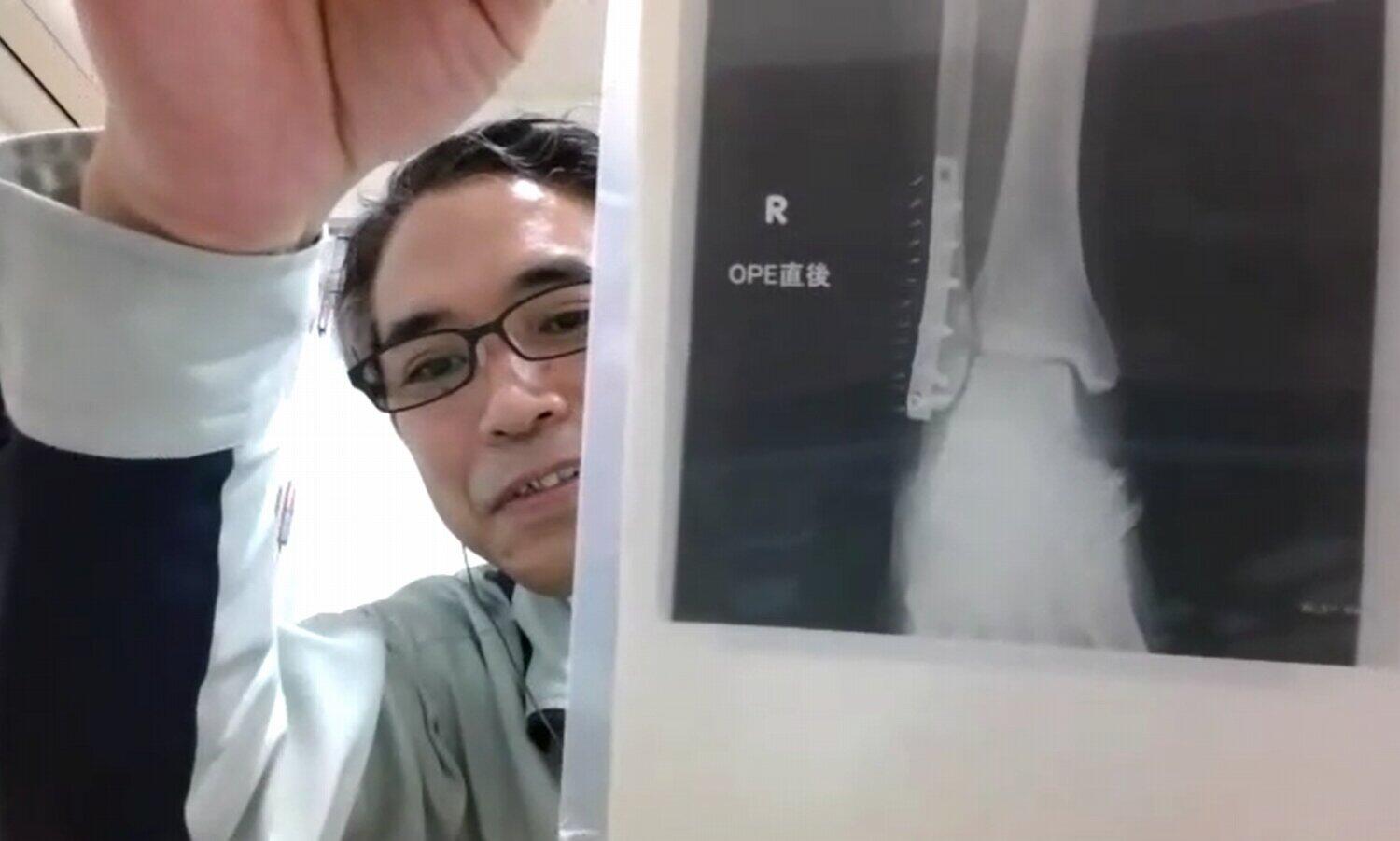 上野さんは、「『溶けるネジ』があれば、手術が1回で済んだはず」と言って笑う。