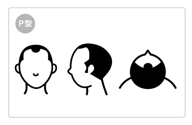 P型（半島状になるパターン）