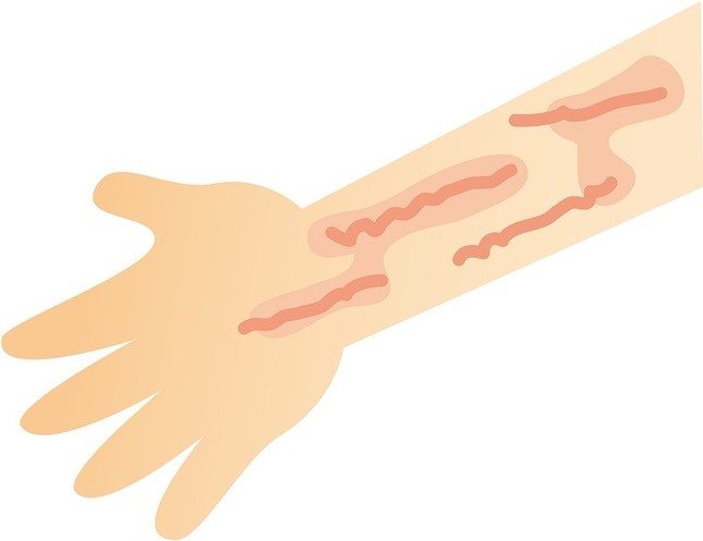 寒い季節特有の症状ではない、寒冷じんましん