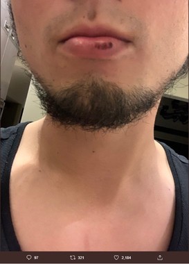 あんこで唇を火傷をしたというダルビッシュ投手