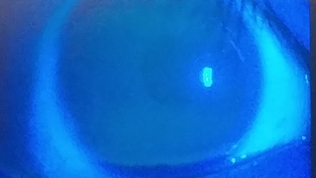 医師からのチェックを受けた記者の角膜。傷はなく「異常なし」の診断結果だった