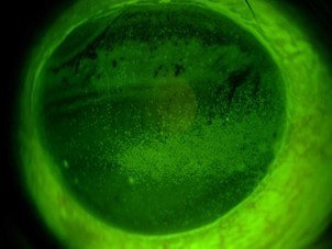 「点状表層角膜症」を患った人の角膜にはハッキリと傷がついているのが分かる（出典：東邦大学医療センター大森病院眼科）