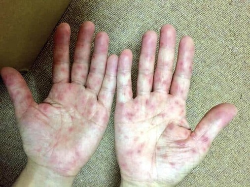 新型コロナウイルス第7波のなかで手足口病が流行　（写真はイメージ）