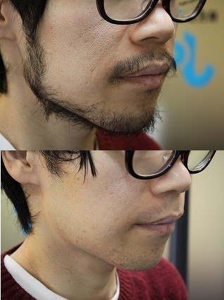 剃る前と後の比較