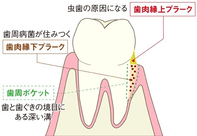 歯周ポケットのプラークは除去が困難（編集部作成）