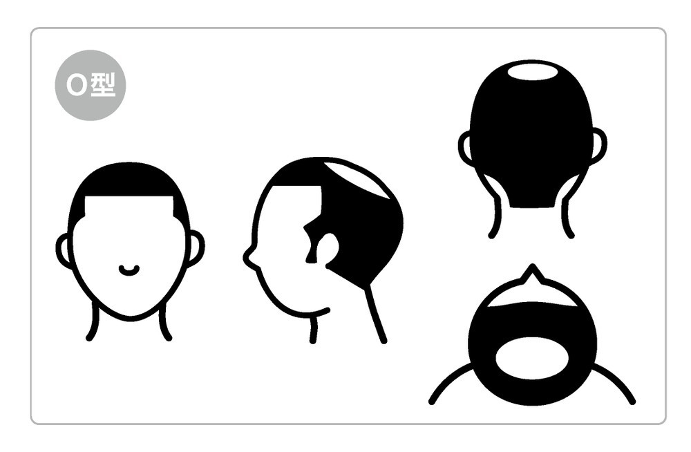 O型（頭頂部が薄くなるパターン）