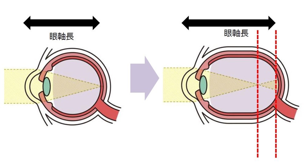 近視のメカニズムのひとつは、「眼軸長」が伸びること