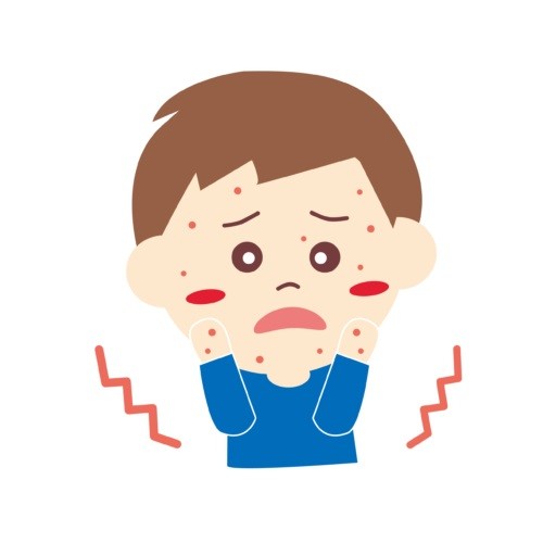 風疹流行、患者数は千人超え　9割以上が予防接種歴「なし」「不明」